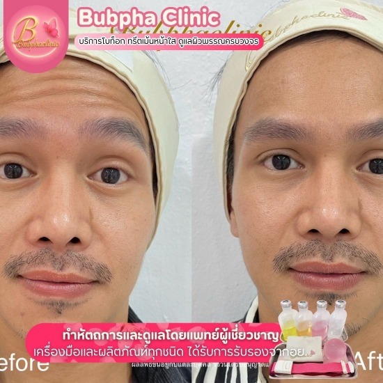 บริการโบท็อก อุดมสุข - บริการโบท็อก ทรีตเม้นหน้าใส อุดมสุข-บุปผา คลินิก